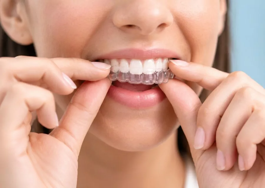 Patient fitting a clear orthodontic aligner